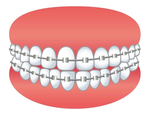 矯正の装置をつけた歯